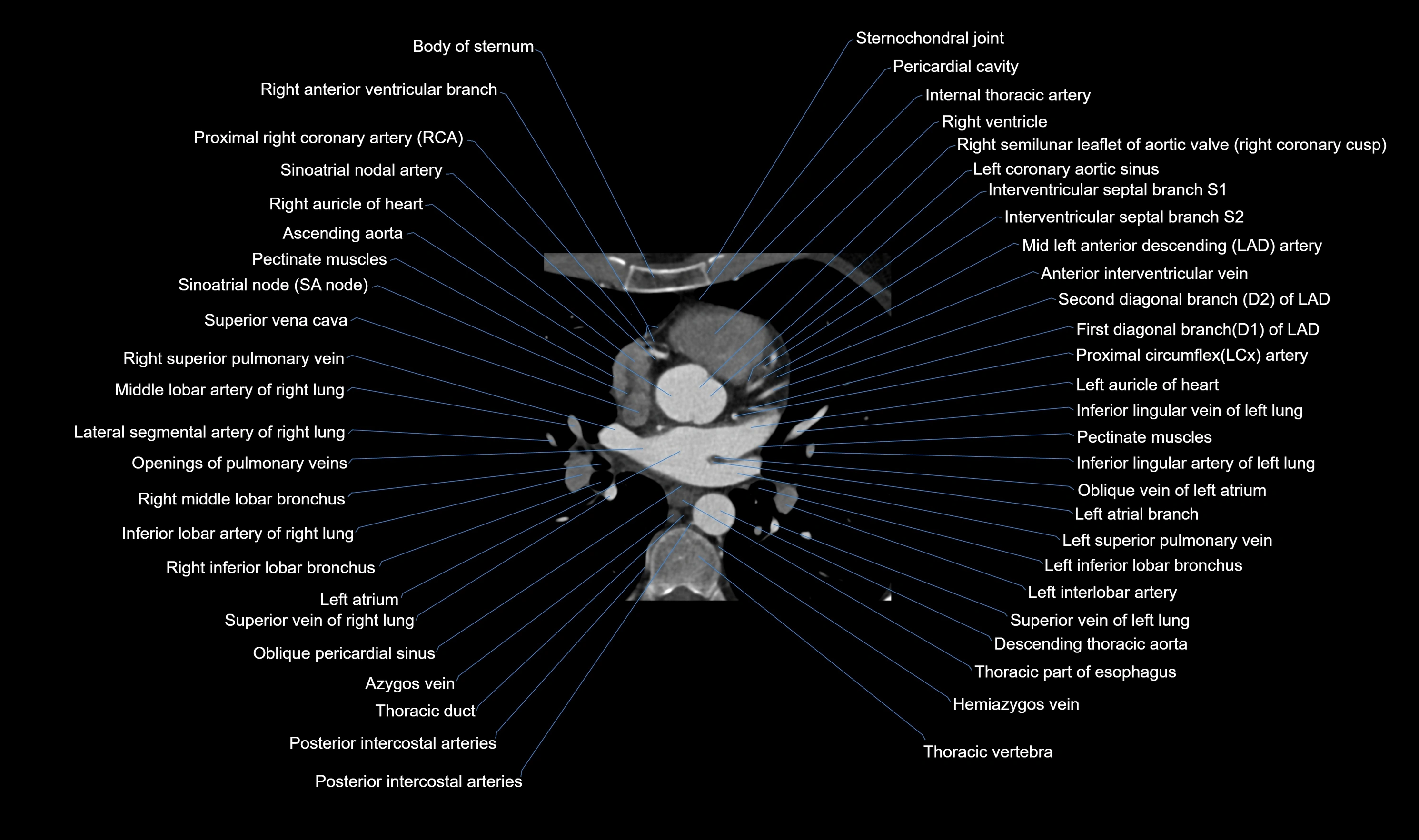 CT heart (coronary angiogram) axial view cross sectional anatomy labelled radiology image-00024.webp